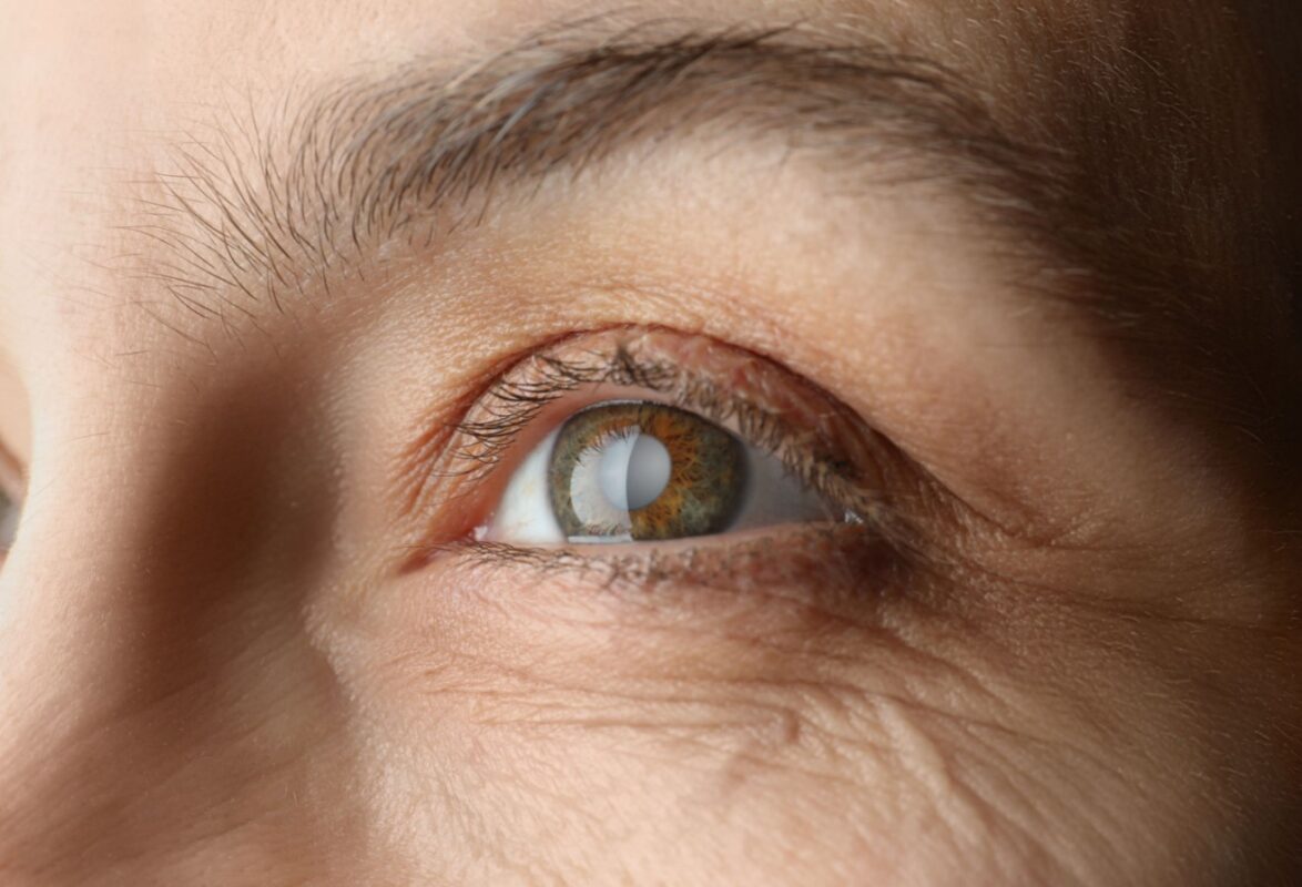 Cataracts Explained: Signs, Symptoms & Treatment Options